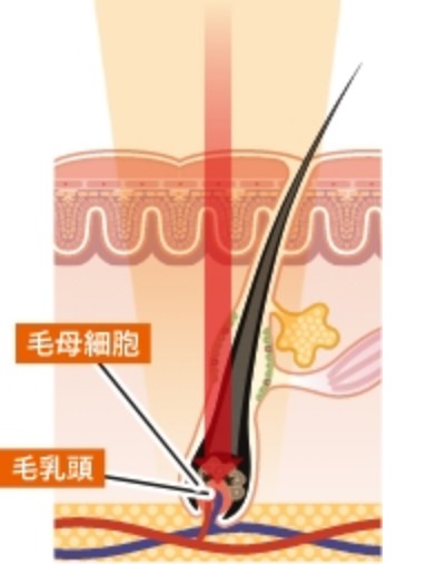 熱破壊式レーザー
