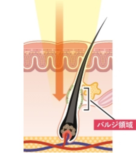 蓄熱式レーザー